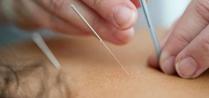 acupuncture training